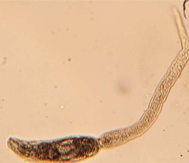 Schistosomiasis