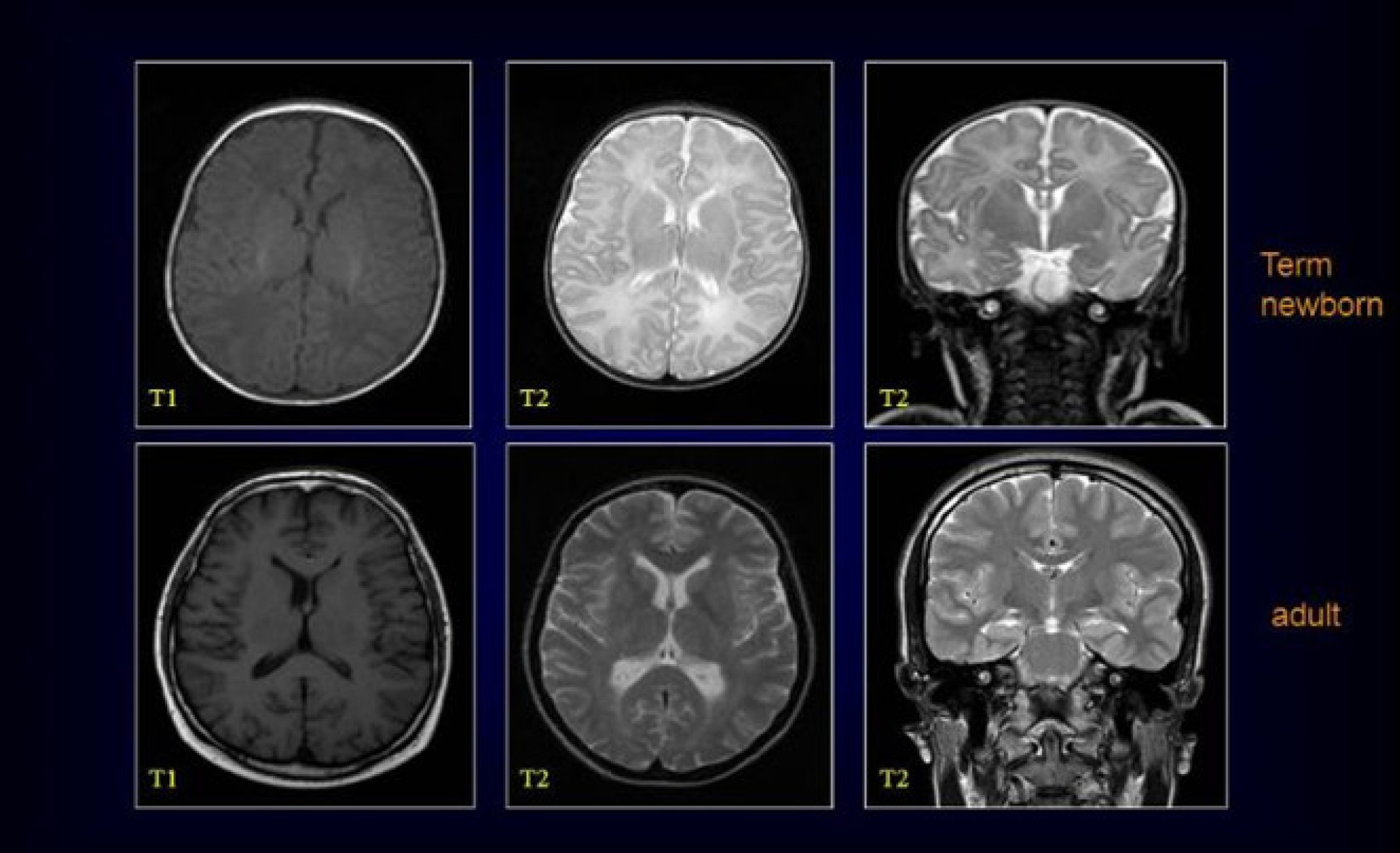 T1 and T2 scans of term newborn babies and adults.