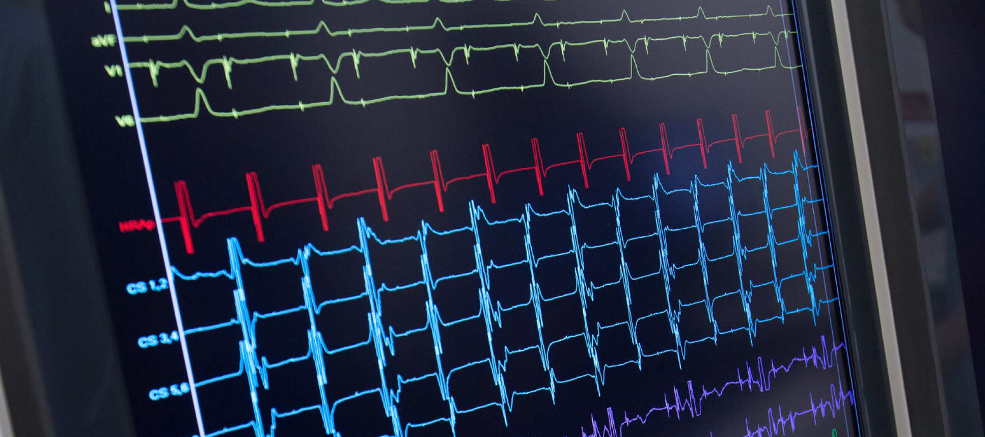 Electrograms