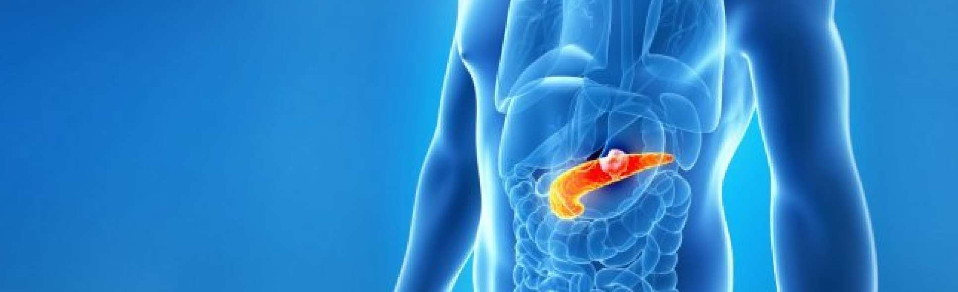 Pancreatic cancer