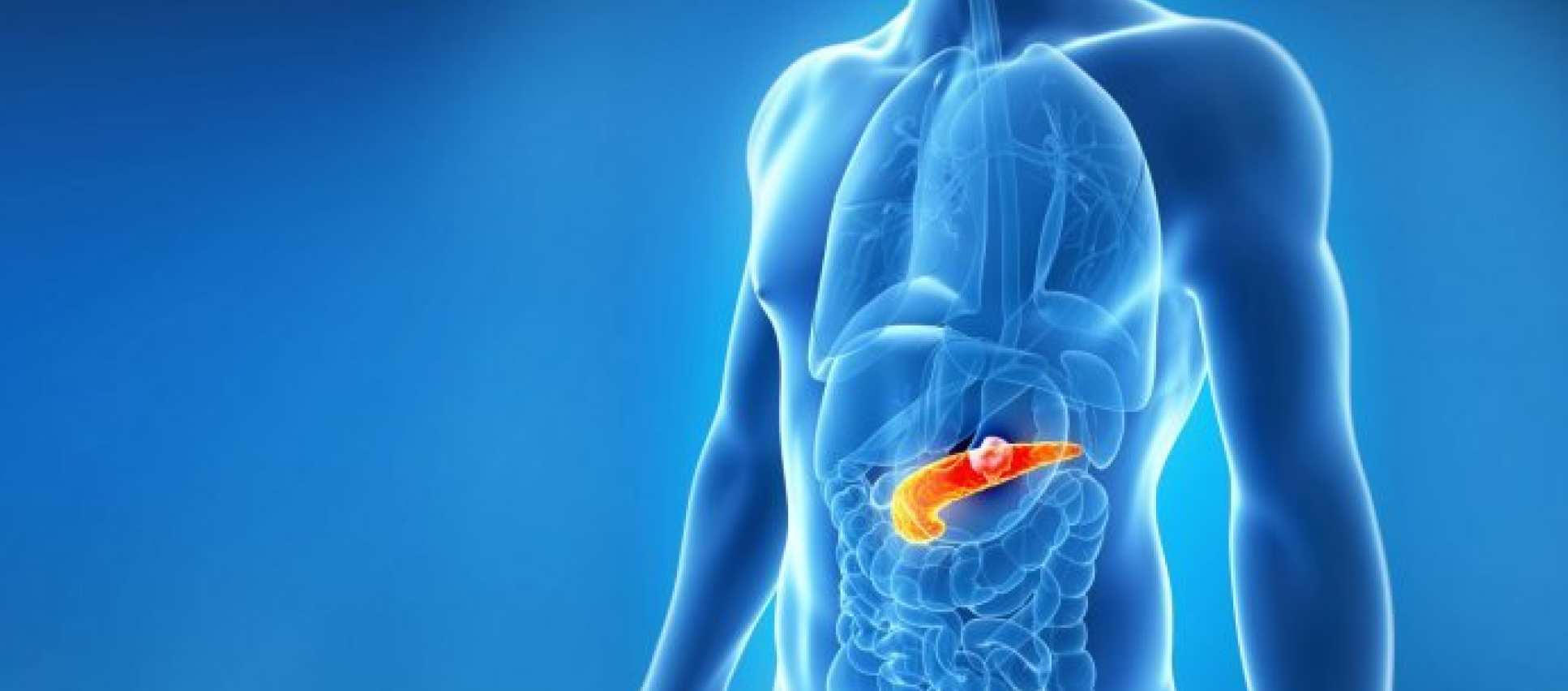 pancreatic cancer