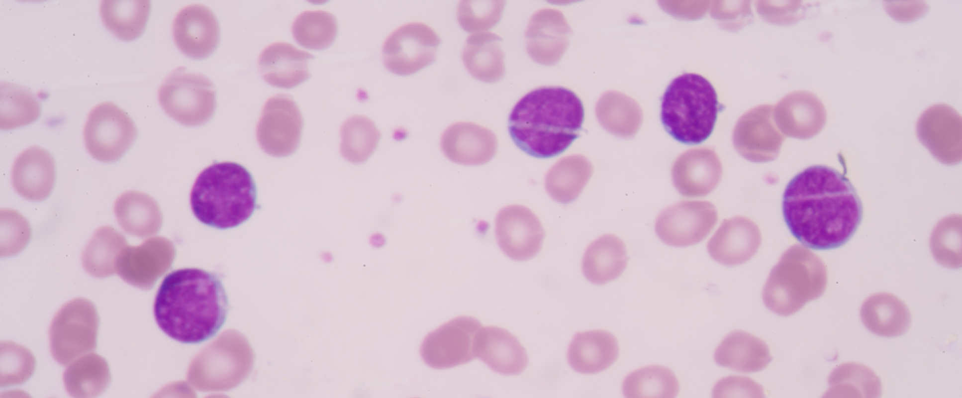 Myeloma