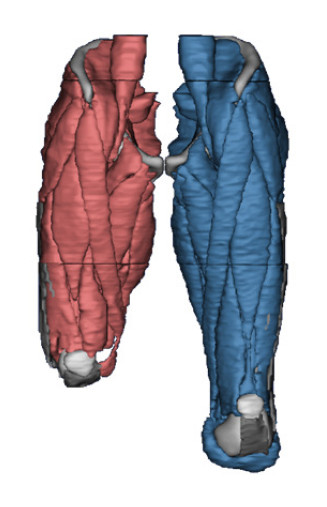 segmented amputee