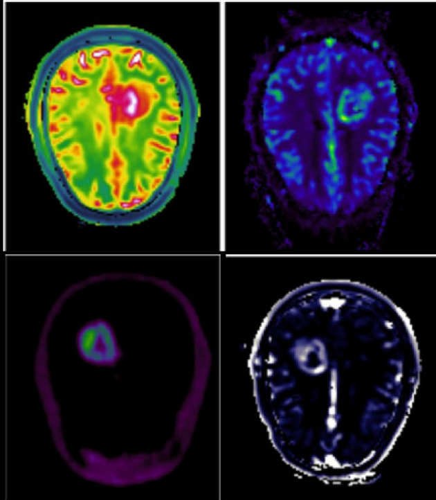 Multiparametric analysis of brain tumours