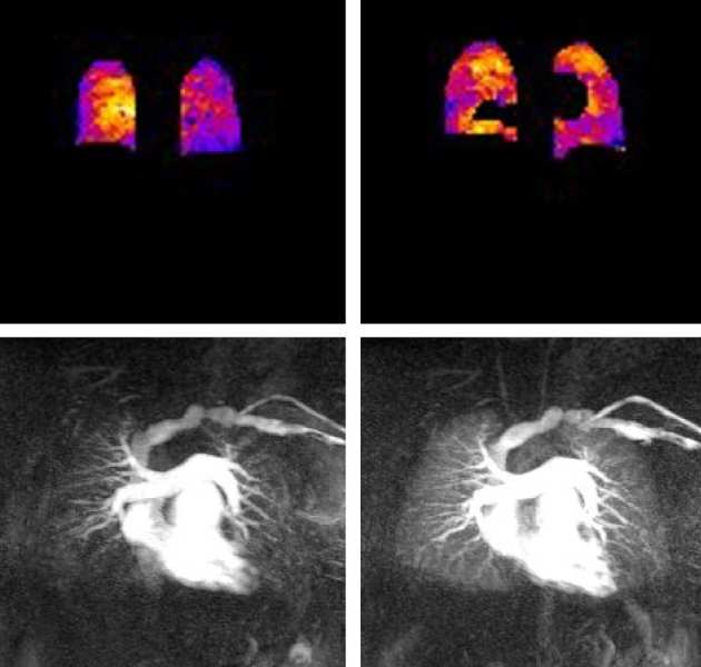 Oxygen enhanced MRI