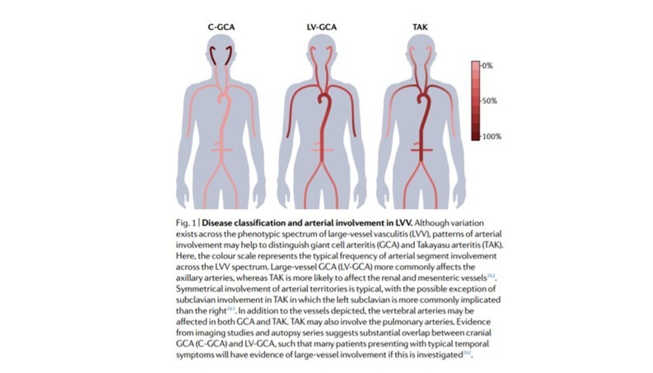 Large Vessel Vasculitis