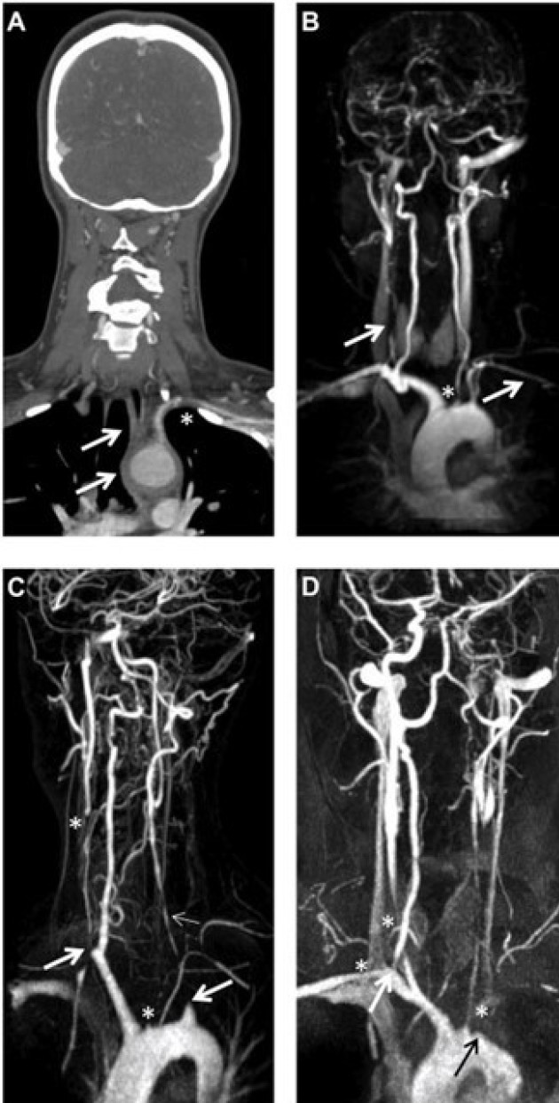 Figure Supra-aortic Takayasu arteritis 