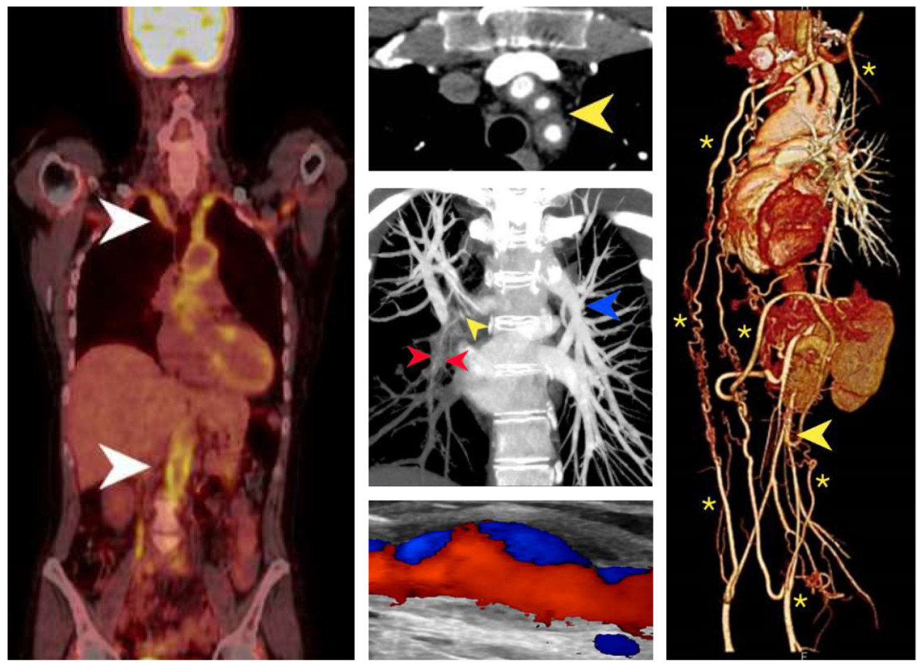 Takayasu Arteritis